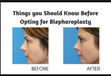 Things you Should Know Before Opting for Blepharoplasty1