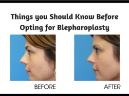 Things you Should Know Before Opting for Blepharoplasty1