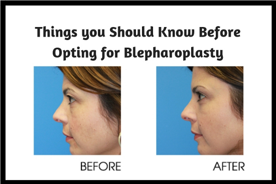 Things you Should Know Before Opting for Blepharoplasty1