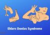 Recently Diagnosed with Ehlers Danlos Syndrome - These Tips Could Help You