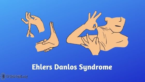 Recently Diagnosed with Ehlers Danlos Syndrome - These Tips Could Help You