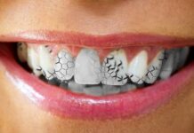 Reasons for Cracked Teeth and What do to About It