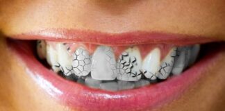 Reasons for Cracked Teeth and What do to About It