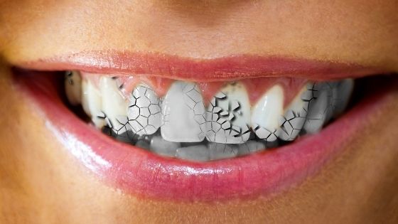 Reasons for Cracked Teeth and What do to About It