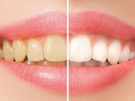 Add A Stunning Touch to Your Selfies with Our Teeth Whitening Kits