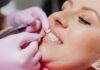 A Comprehensive Approach to Veneers: From Consultation to Maintenance