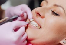 A Comprehensive Approach to Veneers: From Consultation to Maintenance