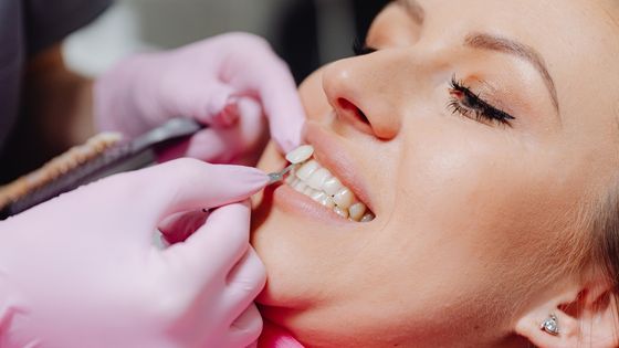 A Comprehensive Approach to Veneers: From Consultation to Maintenance